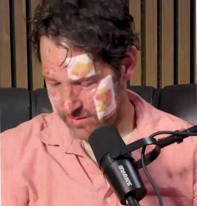 Paul Rudd Burn: Real or Fake?